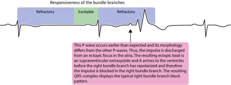 Figure 1. The figure shows a supraventricular extrasystole (i.e a premature atrial complex/beat) which is conducted with aberration. The supraventricular impulse reaches the His-Purkinje system while the right bundle branch is still refractory and therefore blocks the impulse. The resulting QRS complex has a right bundle branch block morphology (rSR pattern), which is due to aberrant ventricular conduction (aberration, aberrancy).