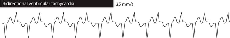 Figure 2. Bidirectional ventricular tachycardia