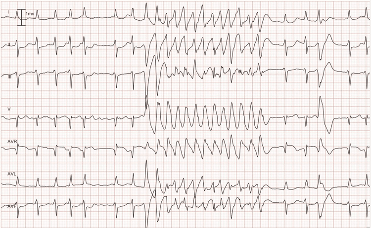 Figure 8. Lead I, II, III, V1 aVR, aVL and aVF. As seen in the beginning of the recording, the patient has an underlying rhythm of atrial fibrillation. The atrial fibrillation is interrupted by a rapid and regular tachycardia with wide QRS complex. Note the 4th beat from the end; it is a premature ventricular beat and its QRS morphology is identical to the QRS seen during the tachycardia. Hence, the tachycardia also originates from the ventricles, which implies that it is ventricular tachycardia (VT).