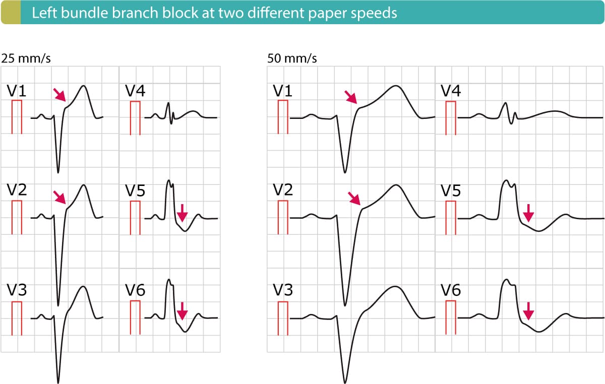 Illustration ur kursen EKG-test (quiz)