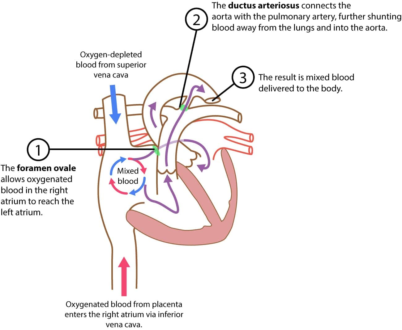 Illustration ur kursen Pædiatrisk og neonatal EKG-tolkning